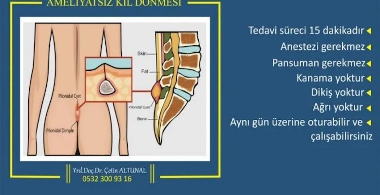 Kıl Dönmesi