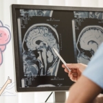 Beyin Tümörü Ameliyatı: Süreç, Riskler ve Modern Cerrahi Yöntemler