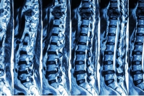 Omurga Kırığı Ameliyatı: Tanı, Tedavi ve Bilimsel Yaklaşım