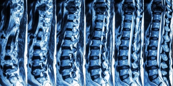 Omurga Kırığı Ameliyatı: Tanı, Tedavi ve Bilimsel Yaklaşım