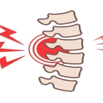 Osteoporozda Omurga Kırıkları