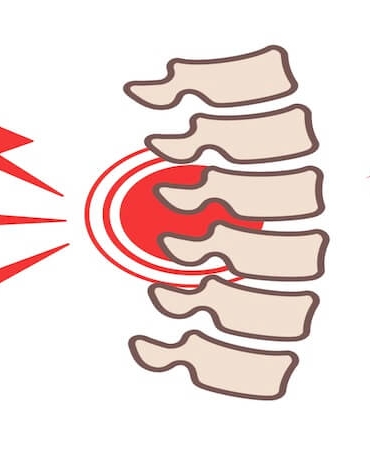 Osteoporozda Omurga Kırıkları