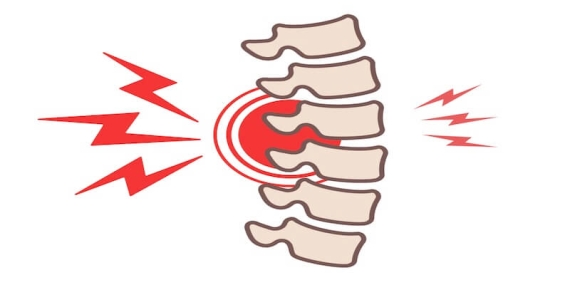 Osteoporozda Omurga Kırıkları