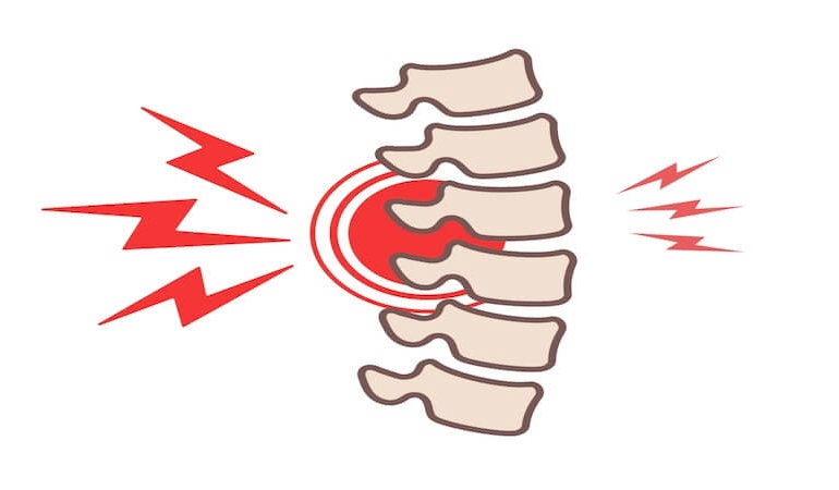Osteoporozda Omurga Kırıkları